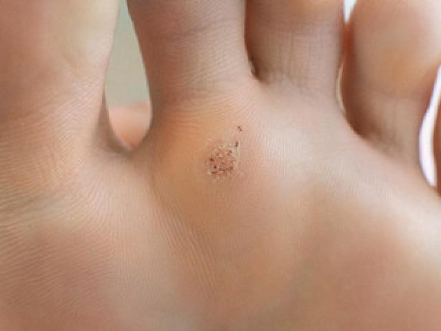 Comment se débarrasser d'une verrue sous le pied ? Protégez le pied des infections.